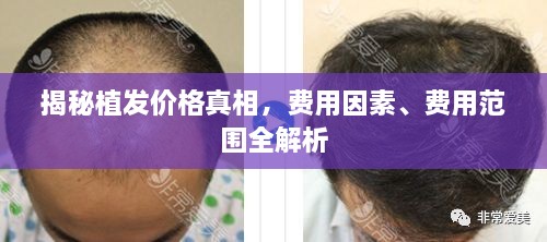 揭秘植發(fā)價(jià)格真相，費(fèi)用因素、費(fèi)用范圍全解析